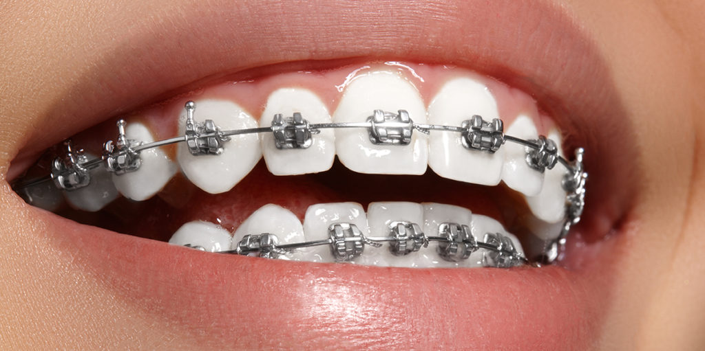 Tratamiento de Ortodoncia en Dental Family Center