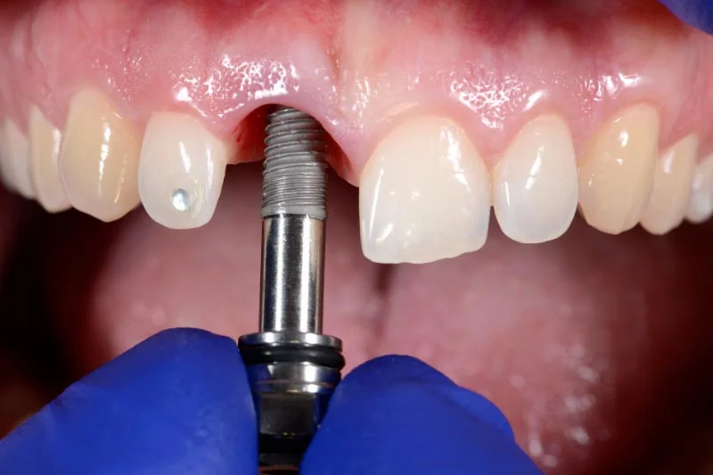 Tratamiento de Implantes dentales en Dental Family Center
